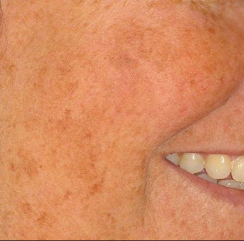Hautverjüngung Gesicht (vorher)
