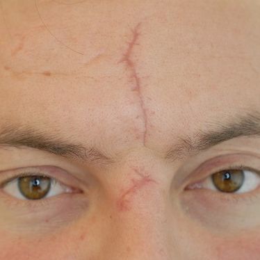 Narbe im Gesicht vor Laserbehandlung