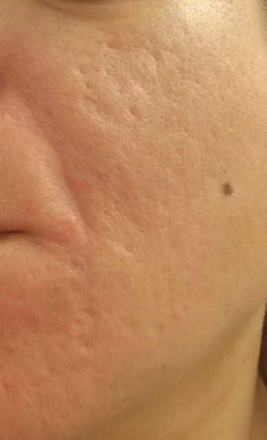 Akne Narbenbehandlung (nachher)