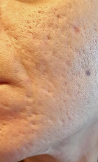 Akne Narbenbehandlung (vorher)