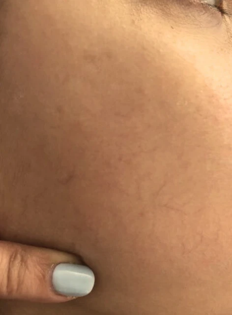 Couperose Wangen (nachher)