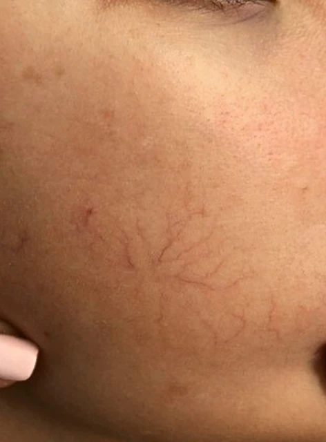 Couperose Wangen vorher