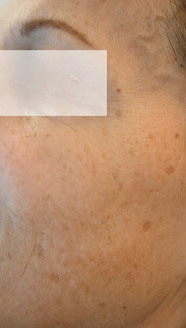 Hautverjüngung Gesicht (vorher)