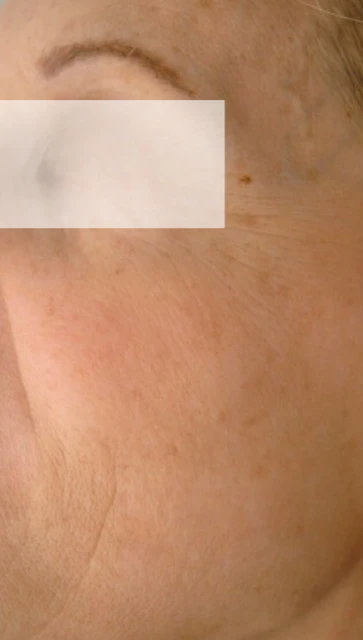 Hautverjüngung Gesicht (nachher)
