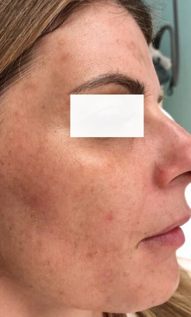 Hautverjüngung Dekolletee (vorher)