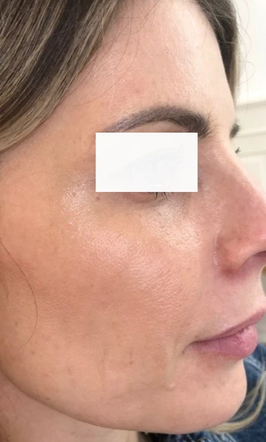 Hautverjüngung Dekolletee (nachher)