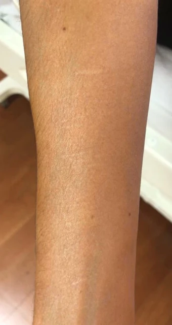 Ritz-Narbe (nachher)