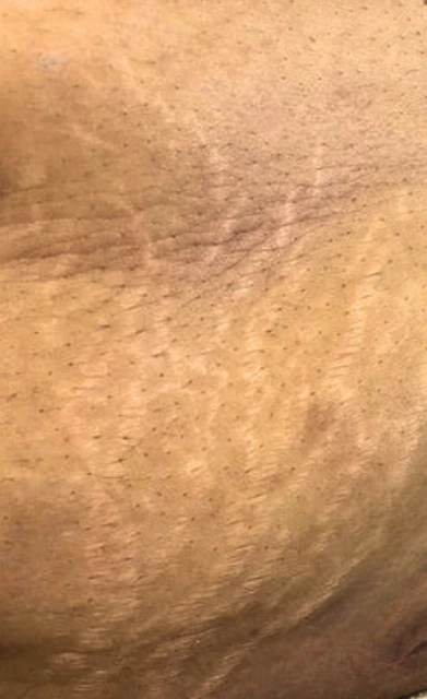 Dehnungsstreifen entfernen (vorher)