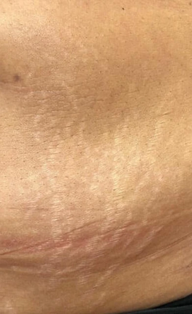 Dehnungsstreifen entfernen (nachher)