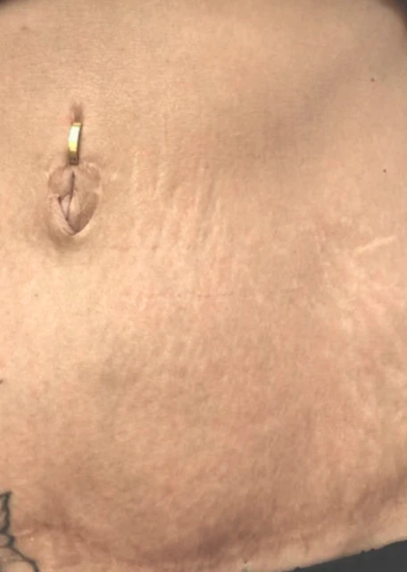 Dehnungsstreifen (vorher)