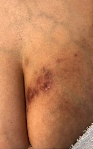 Verbrennungs-Narbe (vorher)